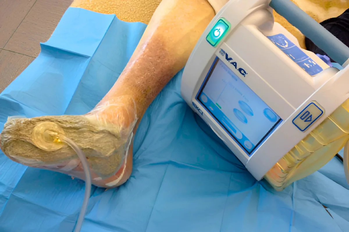 VAC Therapy