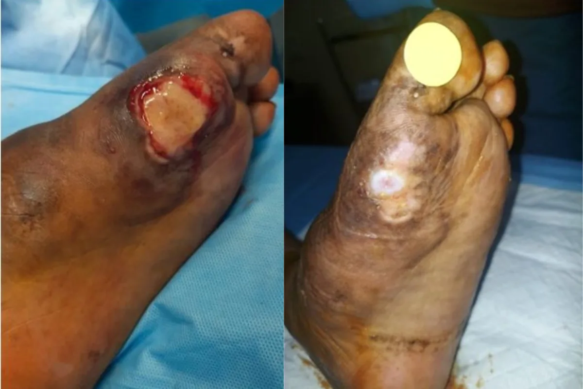 Adipose Grafts