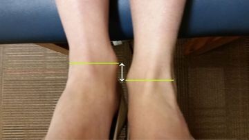 Evaluation and Management of Limb Length Discrepancy